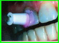 prophy.jpg (5466 Byte)